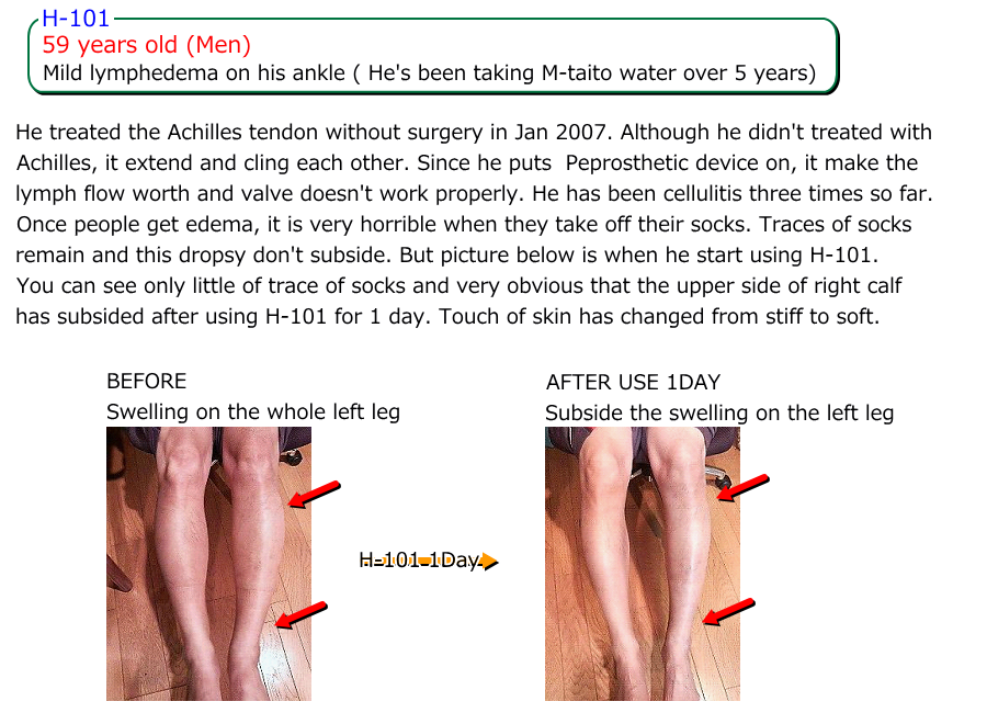 59 years old (Men) Mild lymphedema on his ankle ( He's been taking M-taito water over 5 years) He treated the Achilles tendon without surgery in Jan 2007. Although he didn't treated with Achilles, it extend and cling each other. Since he puts  Peprosthetic device on, it make the lymph flow worth and valve doesn't work properly. He has been cellulitis three times so far. Once people get edema, it is very horrible when they take off their socks. Traces of socks remain and this dropsy don't subside. But picture below is when he start using H-101. You can see only little of trace of socks and very obvious that the upper side of right calf has subsided after using H-101 for 1 day. Touch of skin has changed from stiff to soft. BEFORE. Swelling on the whole left leg. H-101 1Day AFTER USE 1DAY Subside the swelling on the left leg.